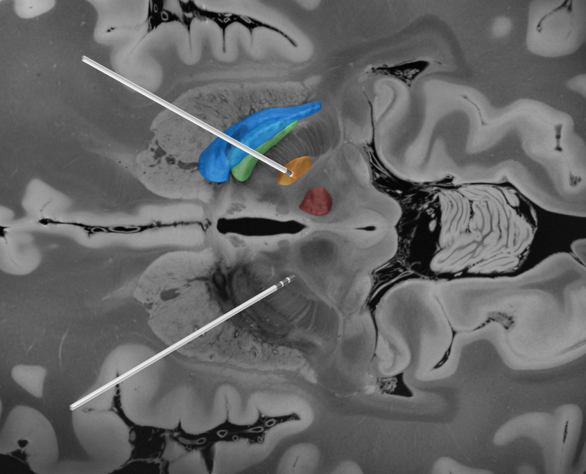 Lead Dbs A Matlab Toolbox Reconstruction And Visualization Of Dbs Electrodes Based On Postoperative Imaging